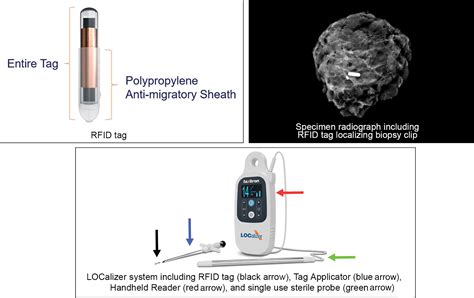 what do the rf tags do placed in cardia area|rfid biopsy tags.